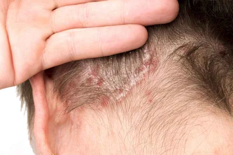How to cure psoriasis completely?