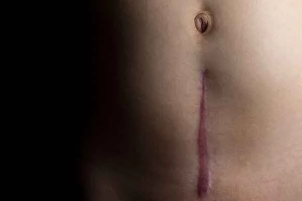 How to remove scars without leaving a mark