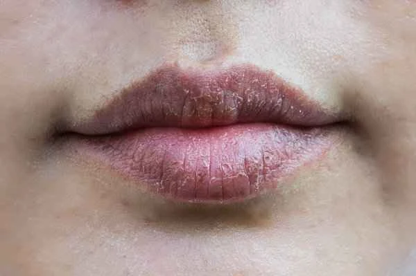 How to remove linear scars on the lips