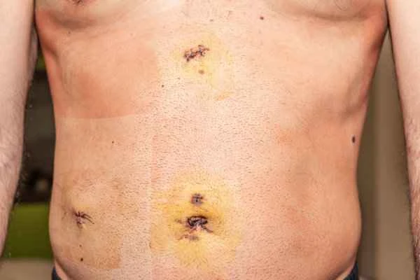How long does it take for postoperative scar adhesions to heal?