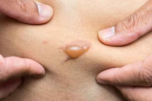 Why does it hurt when you get an injection for keloid scars?