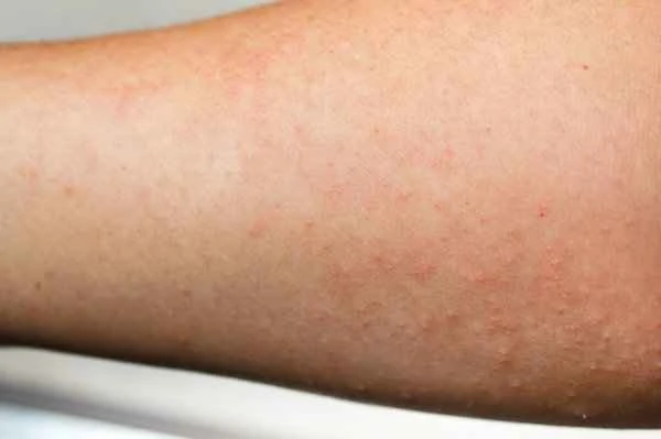 How to treat urticaria quickly?
