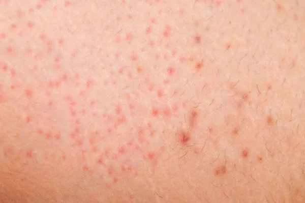 A small black dot on the skin, when squeezed out, produces a long strip.