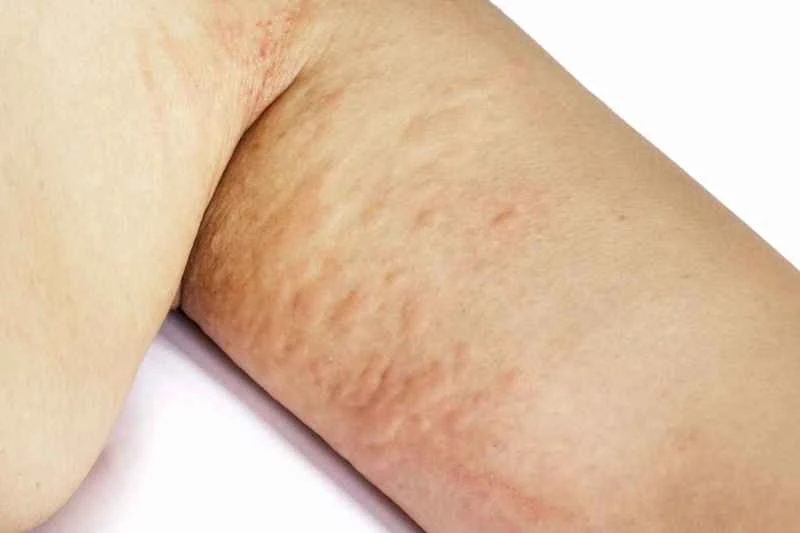 Will cold urticaria in children get better as they grow up?