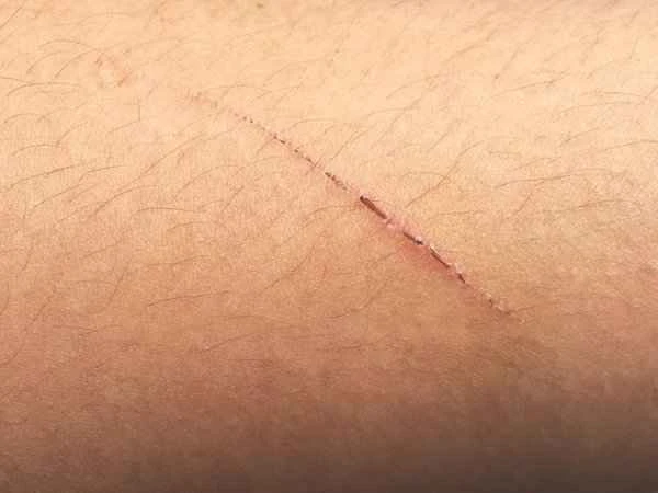 How to repair scratch scars
