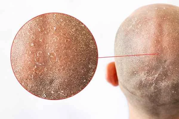 What causes hair loss and how is it treated?