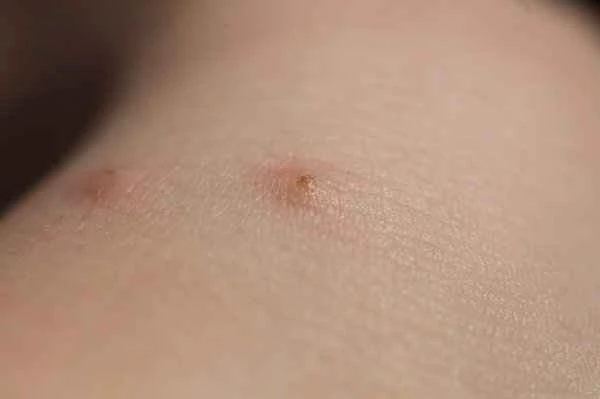 What should I do if my body feels itchy, like bugs are crawling on it?