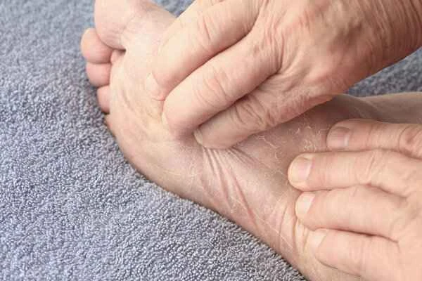 How to treat fungal infections on the soles of the feet