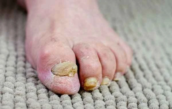 Is onychomycosis (fungal nail infection) contagious?