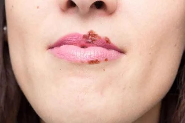 What ointment should I use for cheilitis with pus?