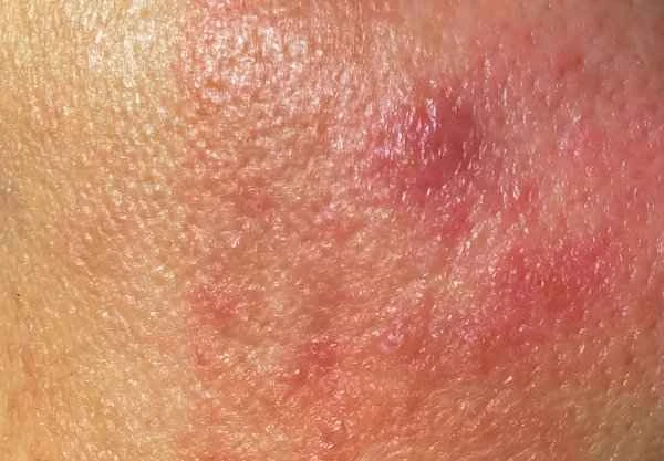 What to do about green scars on the waist?