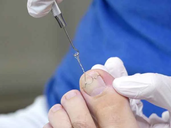 Is onychomycosis (fungal nail infection) contagious?