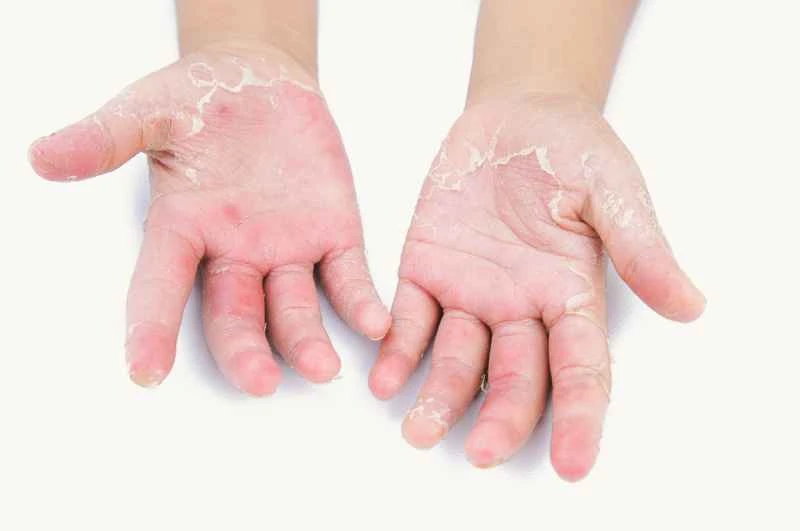 Is dermatitis/eczema contagious?