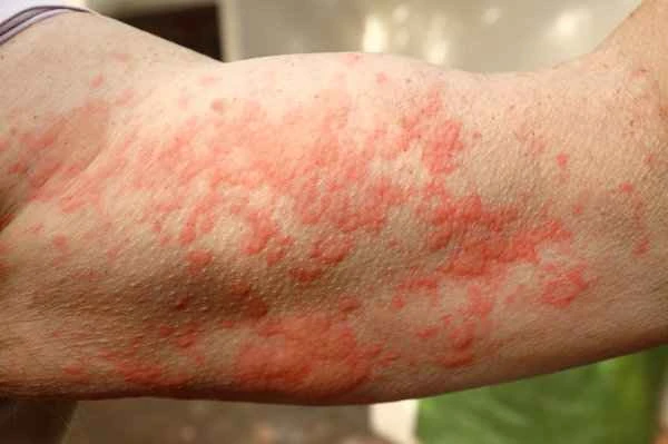 Why does eczema itch more at night?