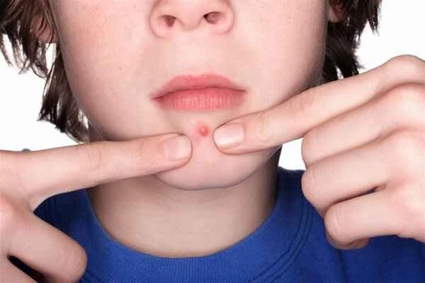 How to soften acne scars