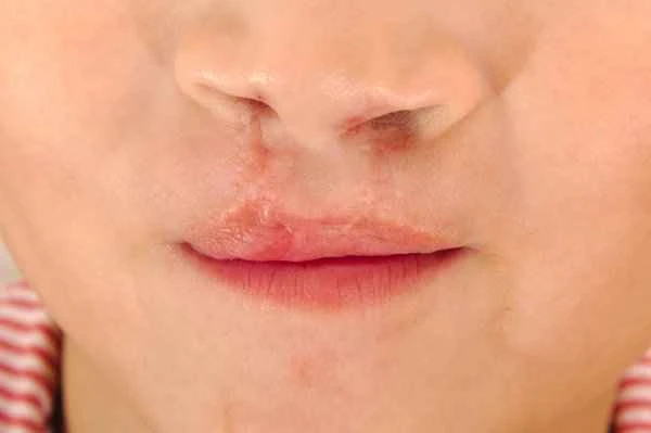 What to do about mucosal depression scars?