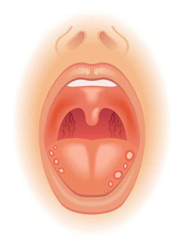 How to treat exfoliative cheilitis