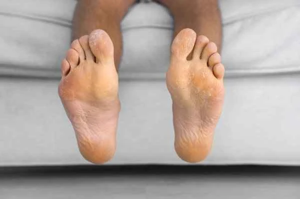 How to cure stubborn athlete's foot?