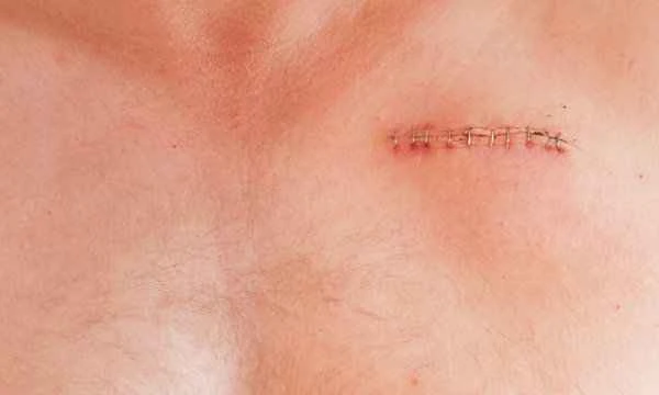 How to tell if a scar is on the chest