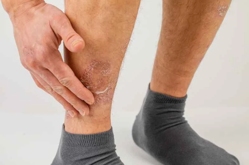 Can psoriasis spread to the whole body?