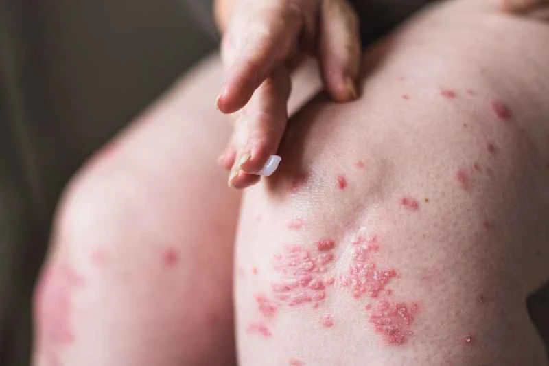 Is eczema in children contagious?