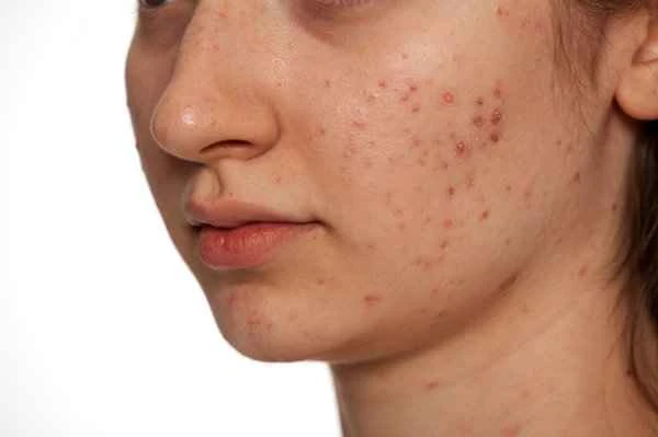 What medicine can help acne heal quickly?