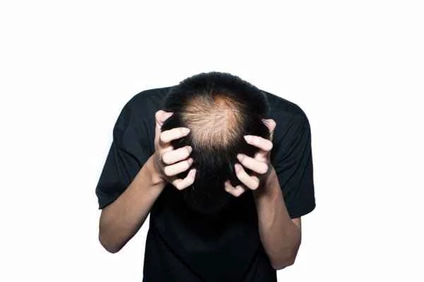 Does a blood test for hair loss require fasting?