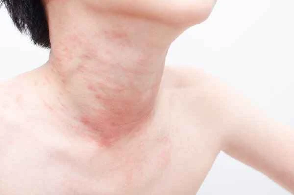 How long does it take to treat acute urticaria?