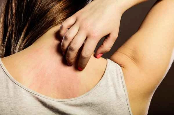 How to relieve itching in keloid scars?