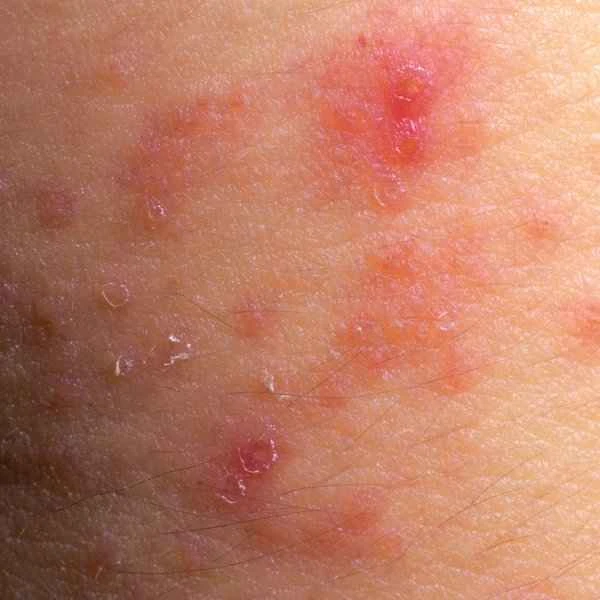 How to remove keloids from eczema