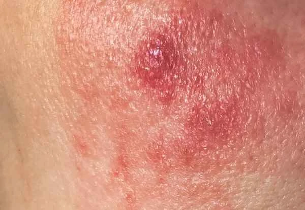 How to remove red and swollen pimples from surgical scars?