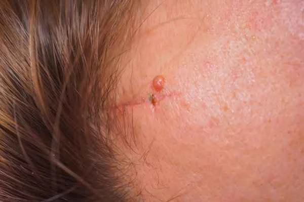 How long does it take for a pressure bandage to heal a keloid scar on the forehead?
