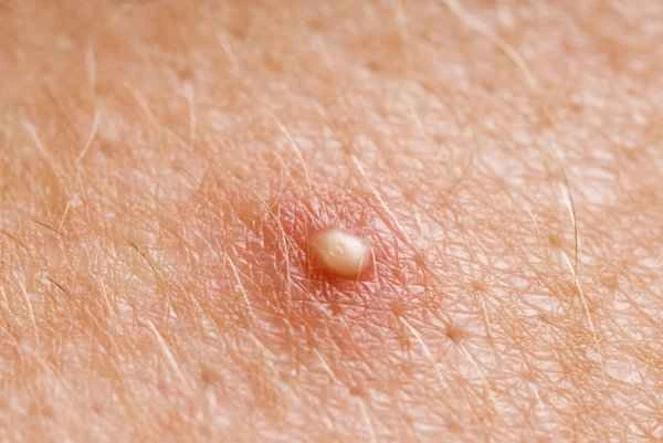 Small white spots, like pimples, on the penis