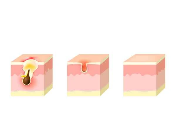 How to treat shingles after half a month?