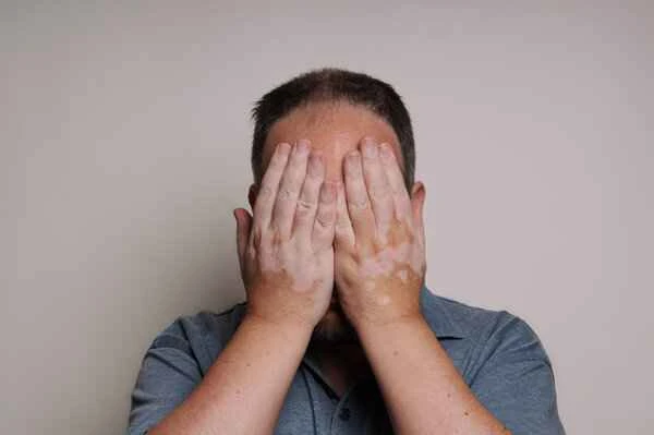 Why does vitiligo always recur in the spring?