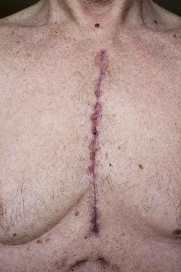 How can scars disappear quickly?