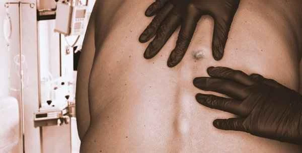 How to cover up keloid scars on the chest