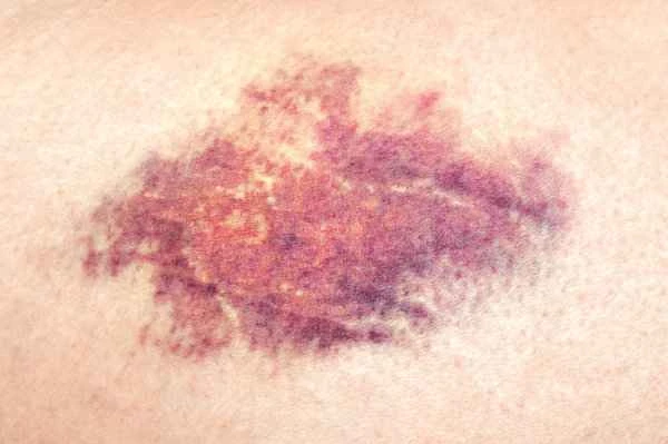 What to do if scars turn black after injection?