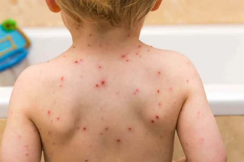 Will cold urticaria in children get better as they grow up?