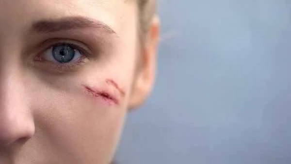 How to best store scar patches