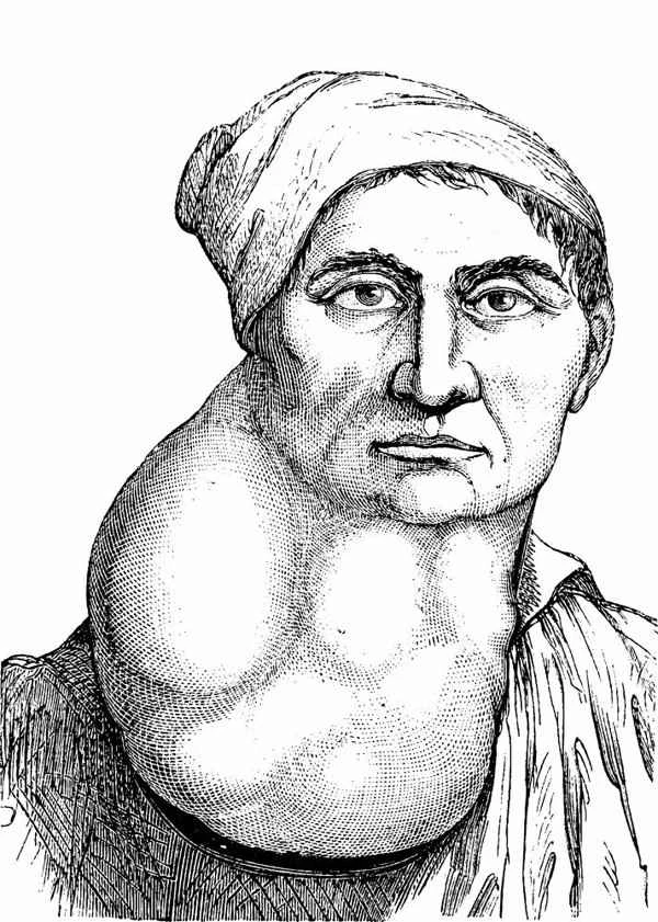 A large lump on the inside of the elbow