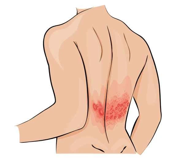Can shingles recur?