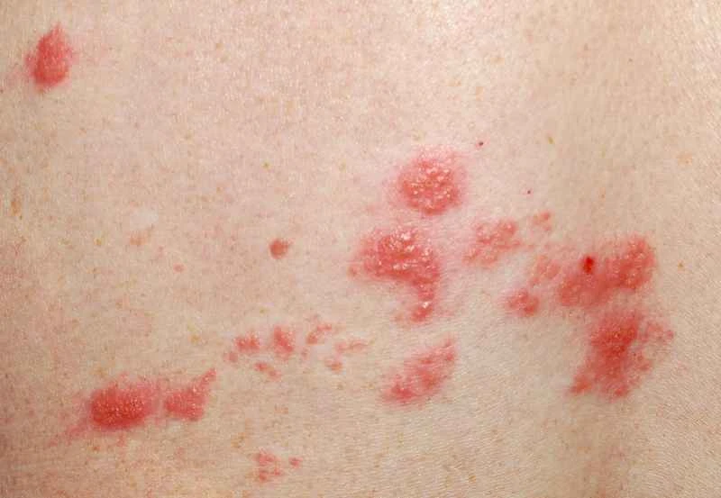 What are the symptoms of urticaria?