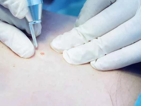 How to care for scars on a daily basis