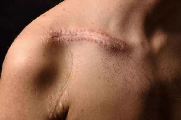 Does surgical scar hurt? How long does it take to heal?