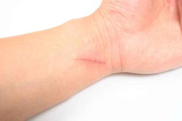 How to stretch and remove scars painlessly