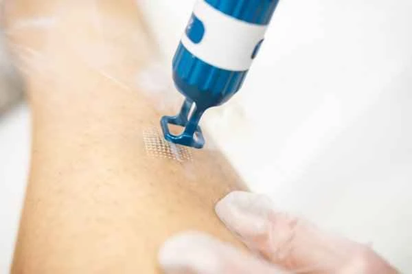 What topical medication should be used for seborrheic dermatitis?