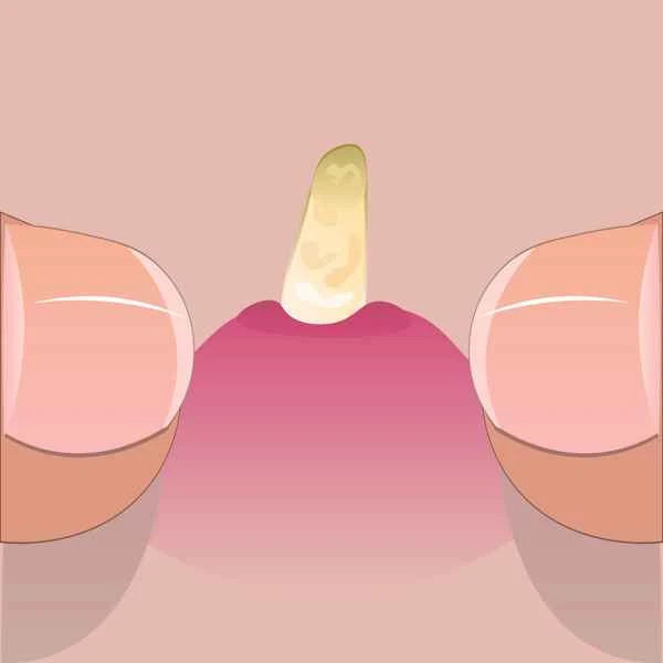 A large boil grew next to the scrotum