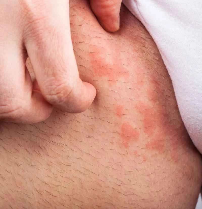 What causes eczema in men?