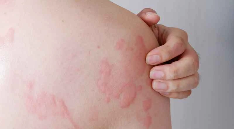 What are some methods to quickly reduce allergic urticaria?